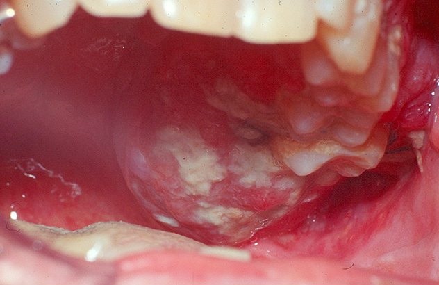 câncer oral imagem mayo clinic00